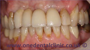 1-dental-implant-after