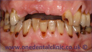 1-dental-implant-before