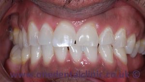 1-teeth-whitening-after