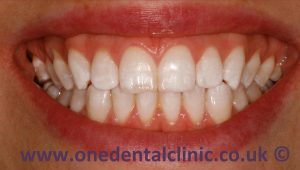 2-dental-fluorosis-after