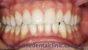 2-teeth-whitening-after