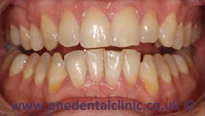 2-teeth-whitening-before