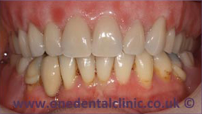 3-dental-implant-after