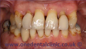 3-dental-implant-before