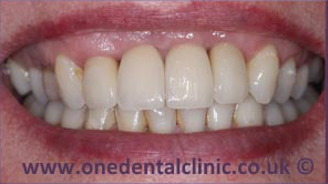 4-dental-implant-after
