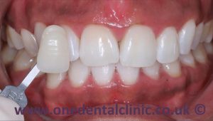 4-teeth-whitening-after
