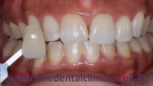 4-teeth-whitening-before