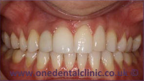 5-dental-implant-after