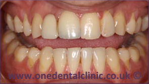 5-dental-implant-before
