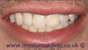 6-dental-implant-after