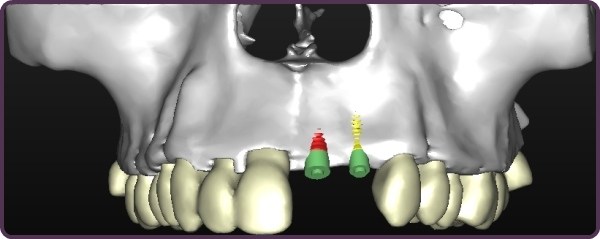 Bone grafting for Dental Implants CT scan