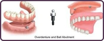Dental Implants Overdentures