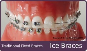 Ice Braces compared against traditional braces