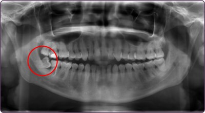 impacted-wisdom-tooth