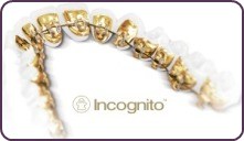 Incognito invisible braces