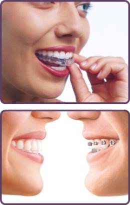 See how easy it is to fit Invisalign Lite aligner