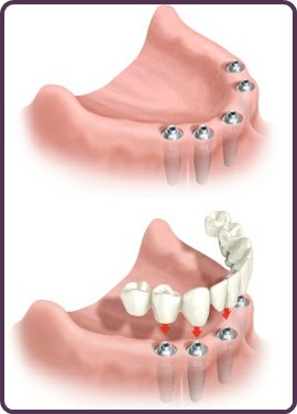 Lower Arch Dental Implants