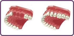 Multiple tooth replacement with implants