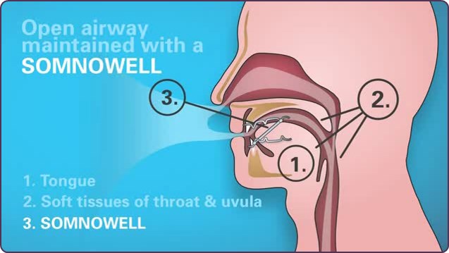 Somnowell device in