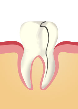 Split-tooth