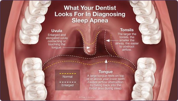 Sleep Apnea Causes