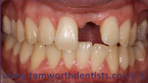 1-Dental-crowns-before