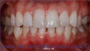 3-invisalign-after