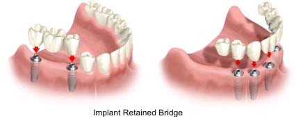 Can dental implants be bridged?