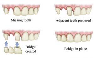 What material are dental bridges made from