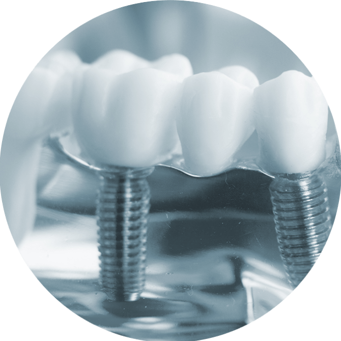 affordable dental implants lichfield